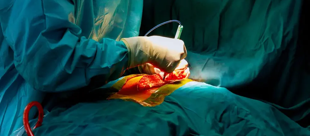 gallbladder surgery in zirakpur