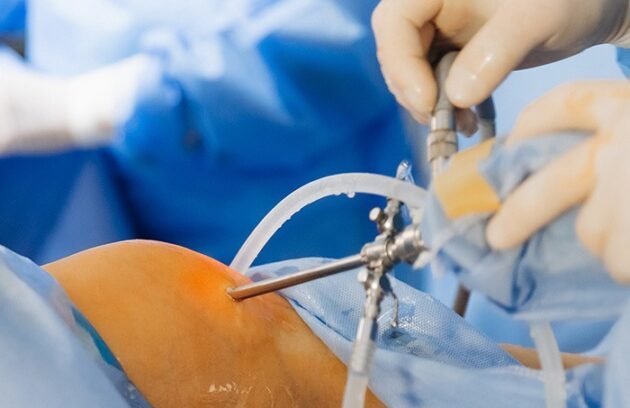 Hernia-Surgery-630x408